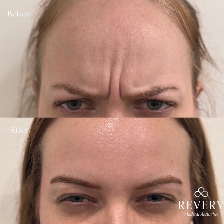 485992060_17955556904924838_5071520229174539254_n botox before and after windsor lasalle