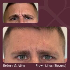 Botox treatment for frown lines at Revery Medical Aesthetics