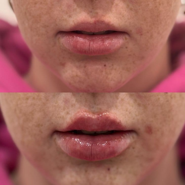 IMG_4442 before and after lip injection windsor lasalle medical aesthetics clinic