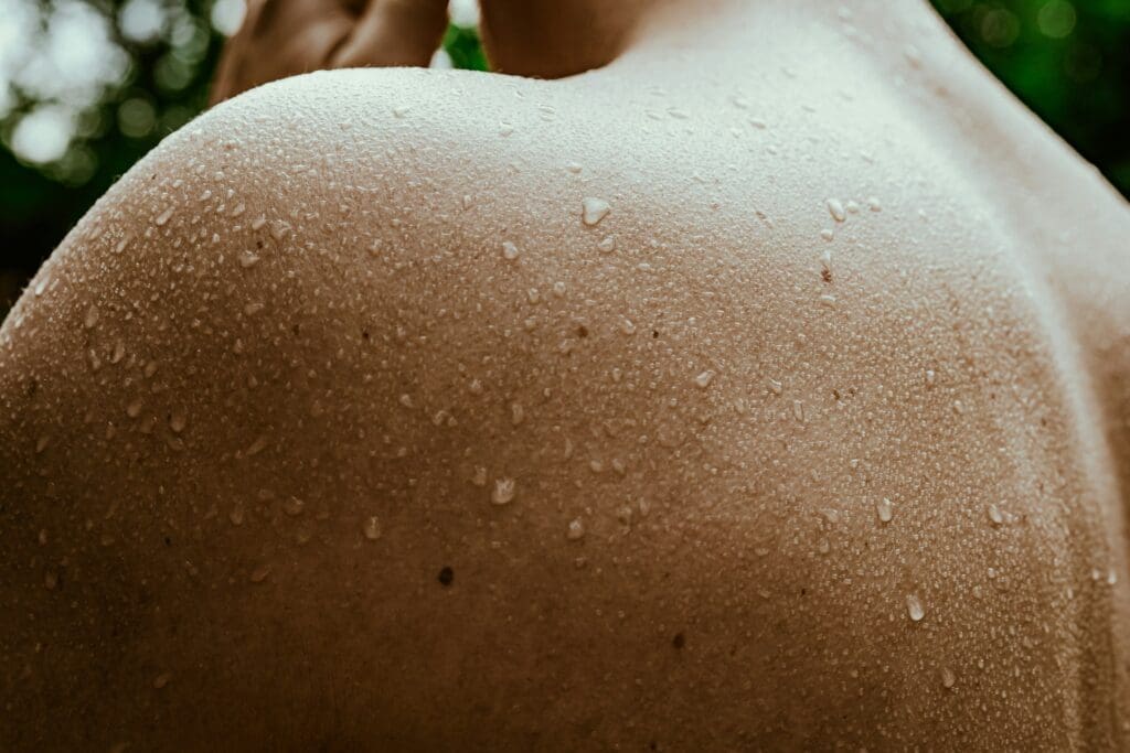 hyperhidrosis treatment windsor