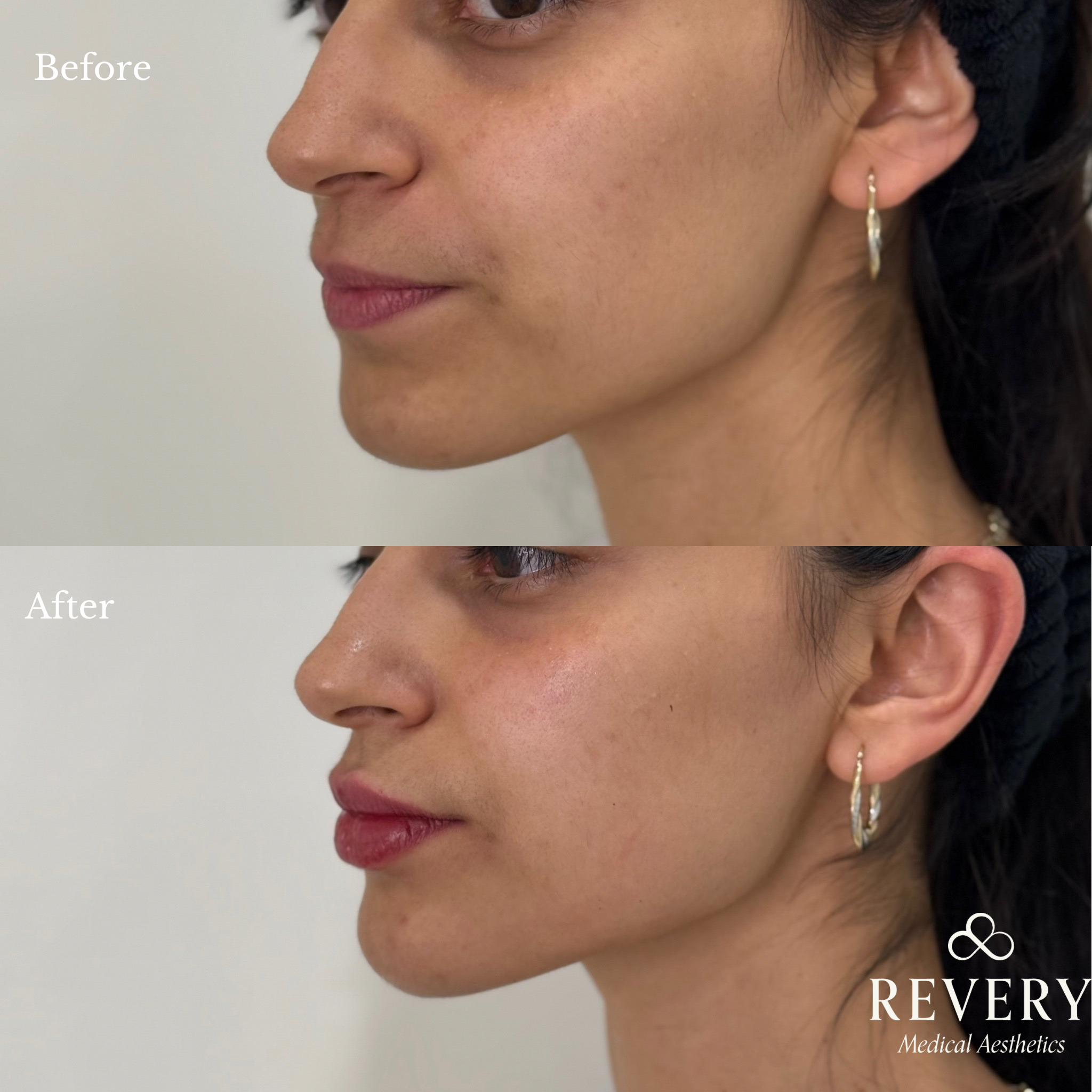dermal fillers before and after windsor
