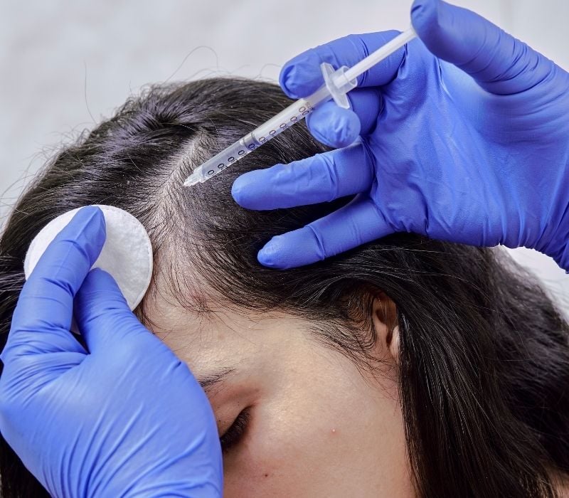 exosomes-hair-restoration windsor hair restoration