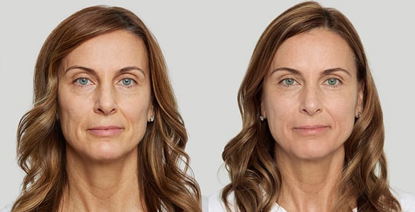 sculptra before and after