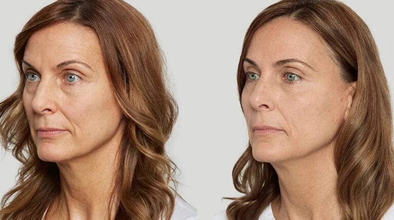 sculptra before and after