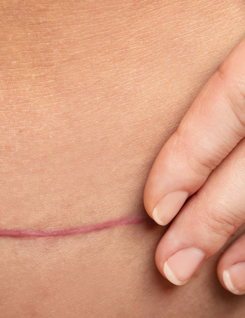 scar scar