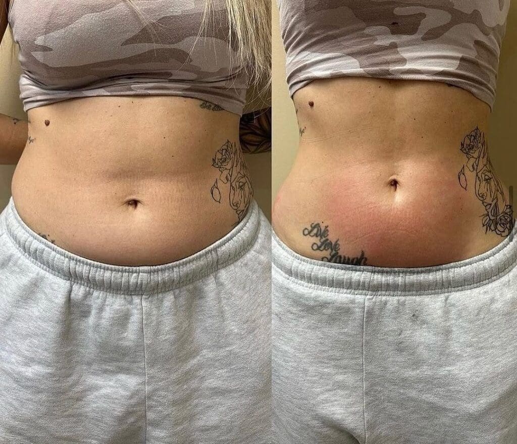 before and after body contouring windsor