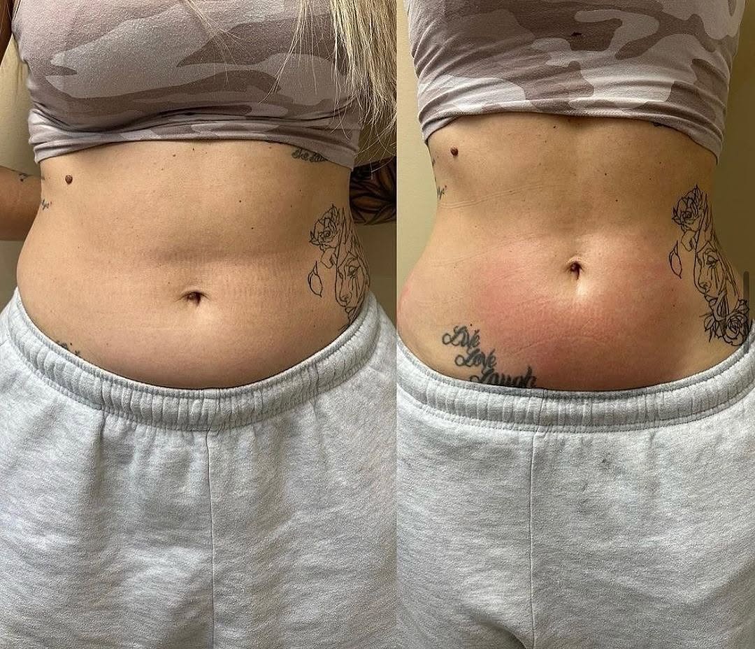 before and after body contouring windsor