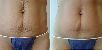 before and after body contouring windsor