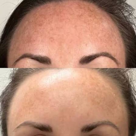 before and after laser skin resurfacing windsor