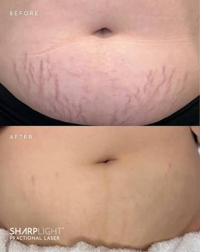 before and after laser skin resurfacing windsor