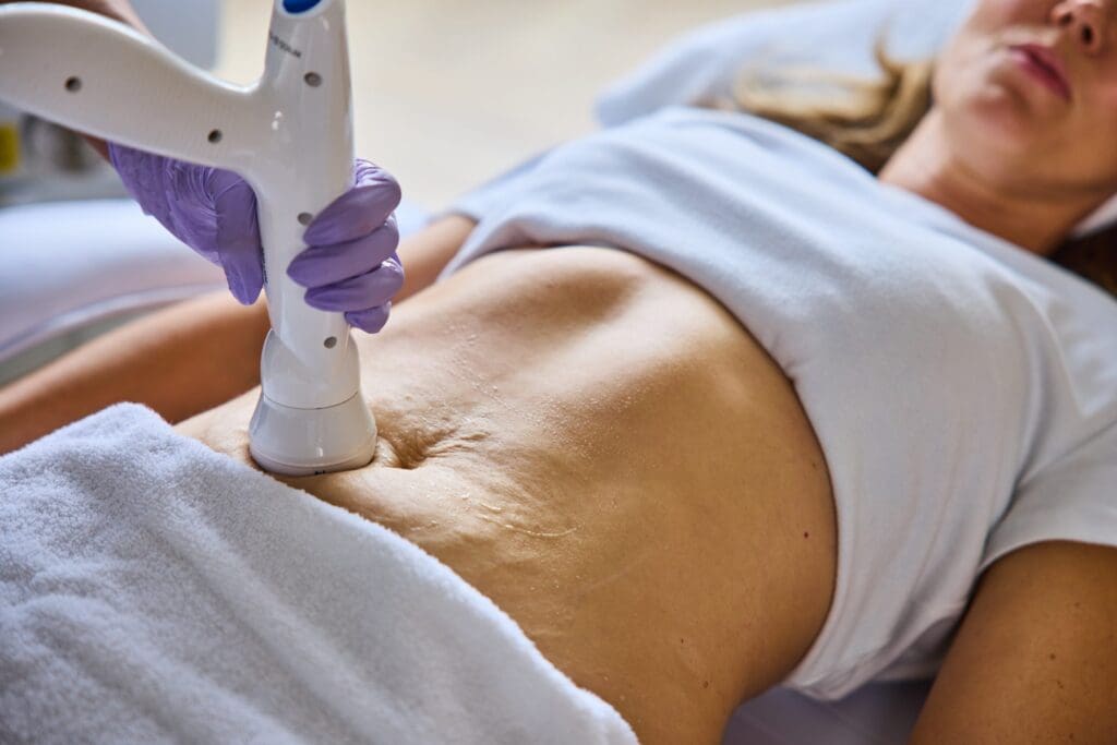 rf body sculpt windsor