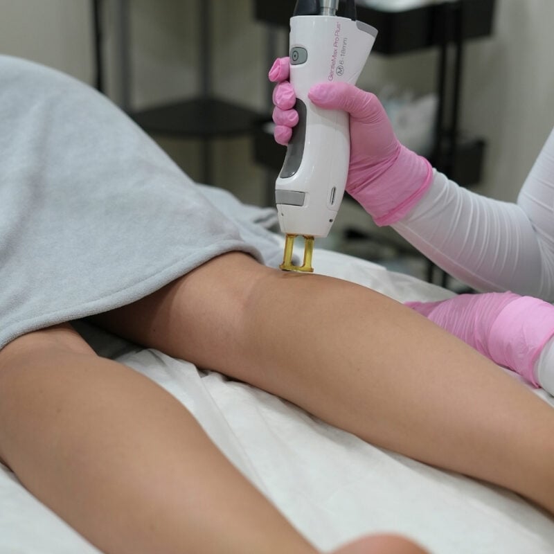 laser-hair-removal-windsor