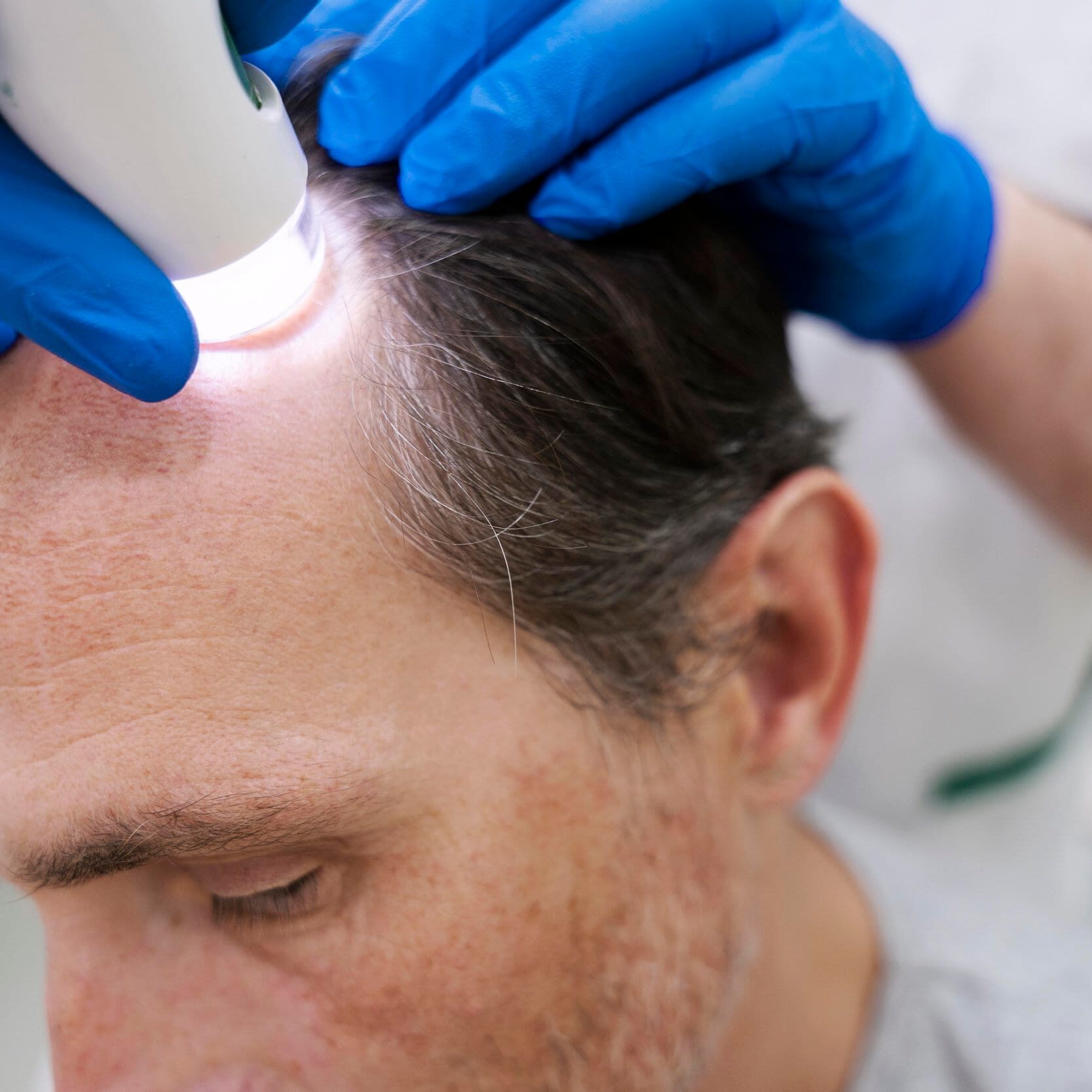 man-getting-microneedling-treatment-hair-loss hair restoration in windsor